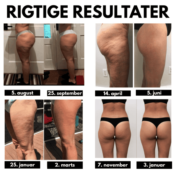 3D-leggings mod cellulitter